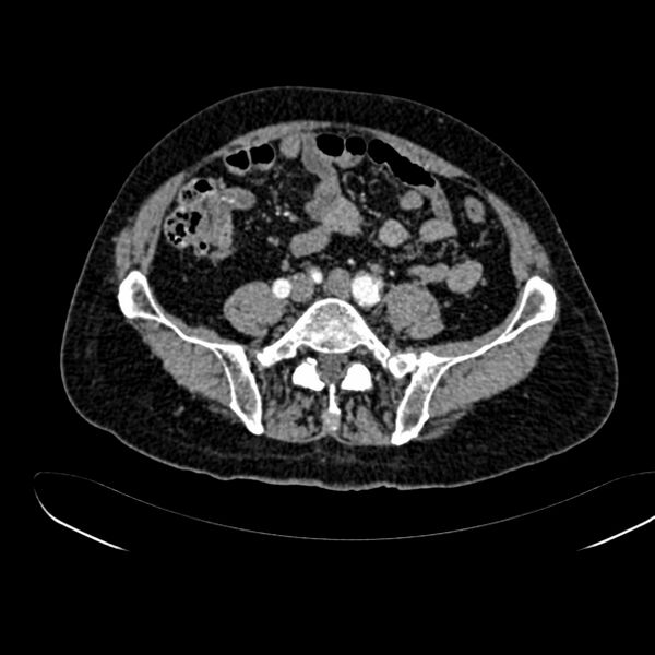 File:Abdominal aortic aneurysm (Radiopaedia 75131-86203 Axial C+ arterial phase 32).jpg