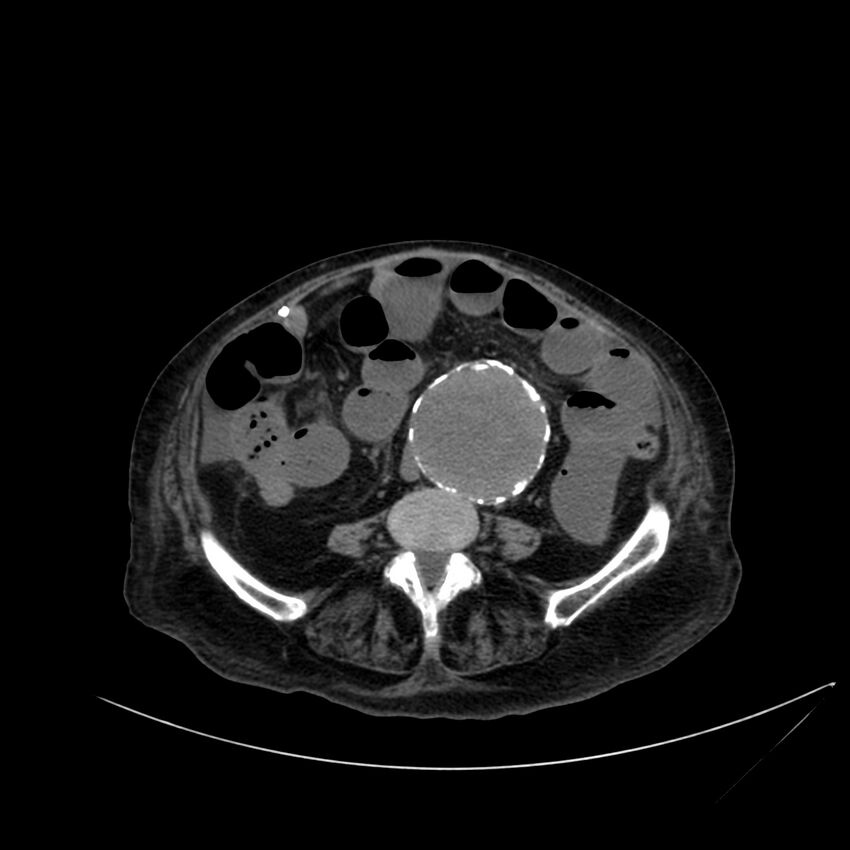 Abdominal aortic aneurysm - impending rupture (Radiopaedia 19233-19246 Axial non-contrast 78).jpg