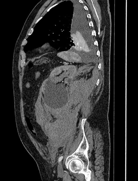 File:Abdominal aortic aneurysm rupture (Radiopaedia 54179-60362 Sagittal C+ arterial phase 34).jpg