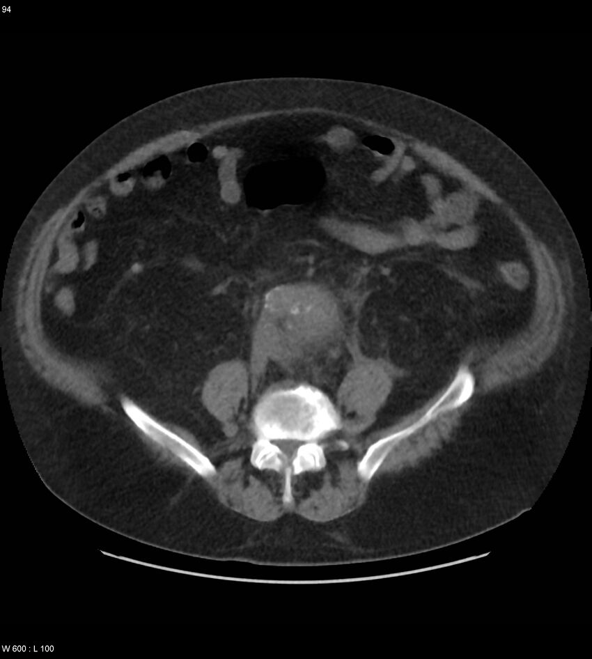 Abdominal aortic aneurysm with intramural hematoma then rupture (Radiopaedia 50278-55631 Axial non-contrast 90).jpg