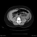 Abdominal wall endometriosis (Radiopaedia 25723-25885 Axial C+ portal venous phase 15).jpg