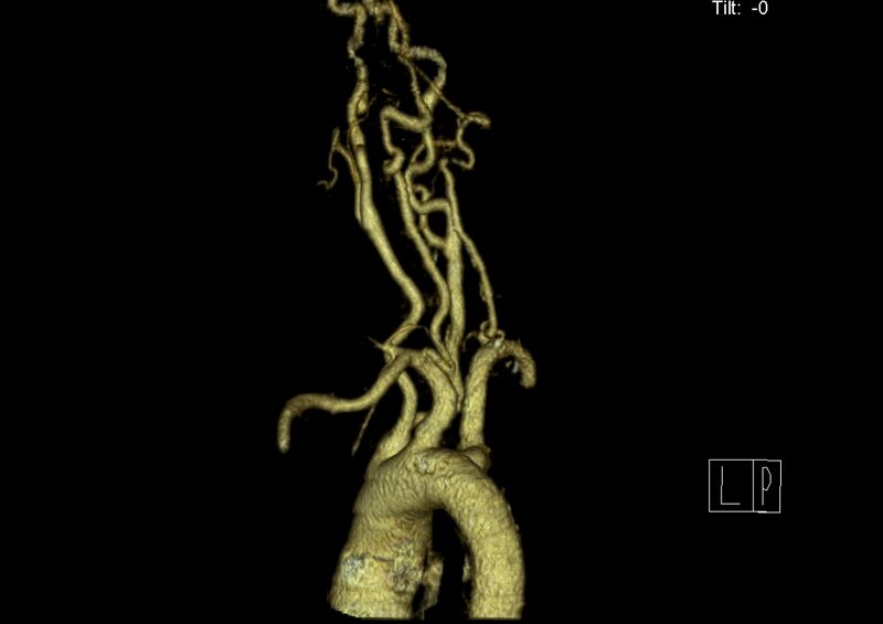 File:Aberrant right subclavian artery (Radiopaedia 19283-19294 3D reconstruction C+ arterial phase 17).jpg