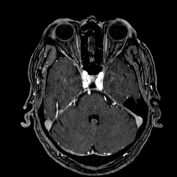 File:Accessory middle cerebral artery (Radiopaedia 73114-83828 Axial MRA 50).jpg