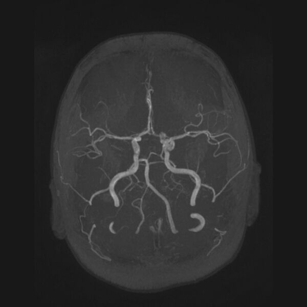 File:Accessory middle cerebral artery and ICA aneurysm (Radiopaedia 22656-22674 B 11).jpg