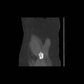 Acetabular fracture (Radiopaedia 13193-13212 Sagittal bone window 2).jpg