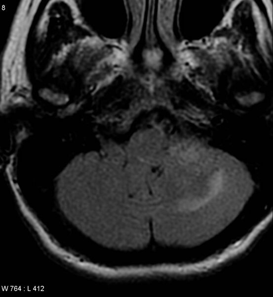 File:Acoustic schwannoma (large with cystic change) (Radiopaedia 5369-7130 Axial FLAIR 2).jpg