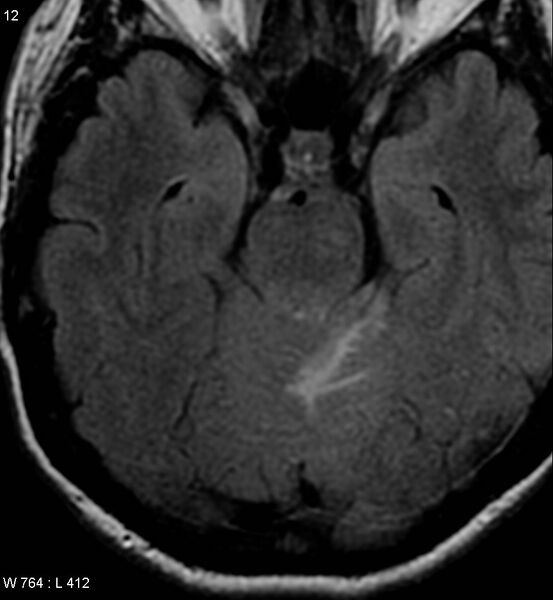 File:Acoustic schwannoma (large with cystic change) (Radiopaedia 5369-7130 Axial FLAIR 6).jpg