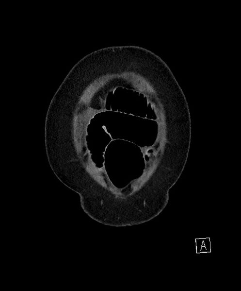 File:Active Crohn disease (Radiopaedia 59394-66750 Coronal C+ portal venous phase 8).jpg