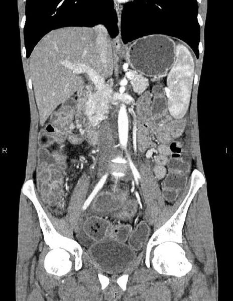 File:Active crohn disease (Radiopaedia 87133-103397 Coronal C+ arterial phase 32).jpg