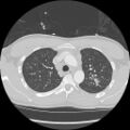Active right ventricular cardiac sarcoidosis (Radiopaedia 55596-62101 Axial lung window 9).jpg