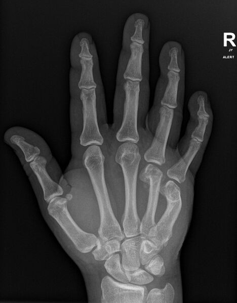 File:Acute 4th metacarpal and old 5th metacarpal fractures (Radiopaedia 79570-92752 Frontal 1).jpg