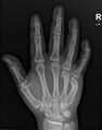 Acute 4th metacarpal and old 5th metacarpal fractures (Radiopaedia 79570-92752 Frontal 1).jpg