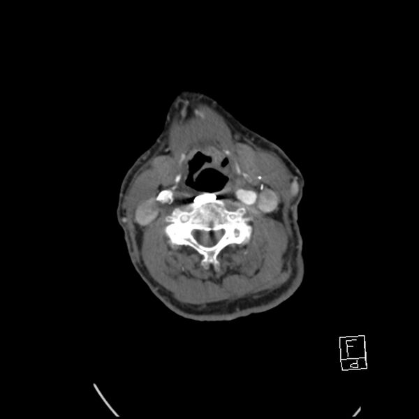 File:Acute ICA ischemic penumbra due to high-grade CCA stenosis (CT perfusion) (Radiopaedia 72038-82530 Axial C+ arterial phase 45).jpg