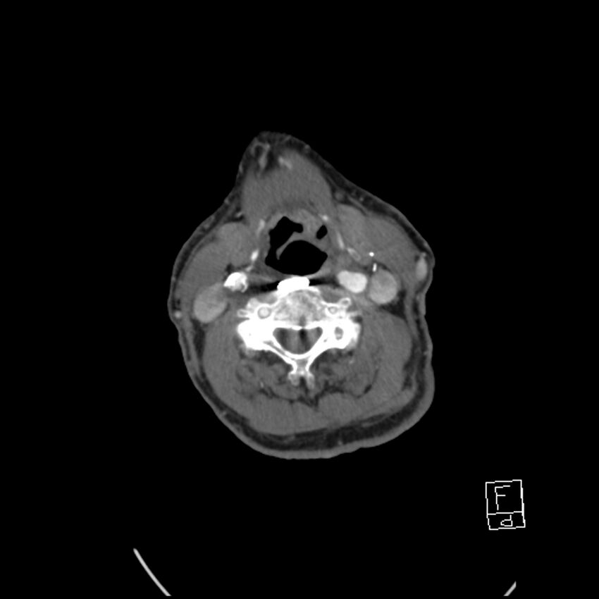 Acute ICA ischemic penumbra due to high-grade CCA stenosis (CT perfusion) (Radiopaedia 72038-82530 Axial C+ arterial phase 45).jpg