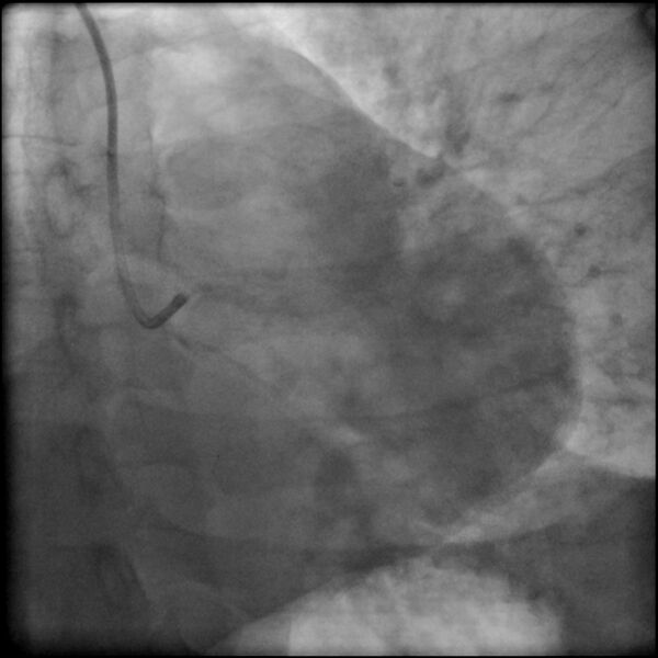 File:Acute anteroseptal myocardial infarction (Radiopaedia 68409-77946 LAO caudal (spider view) LAD and CX 4).jpg