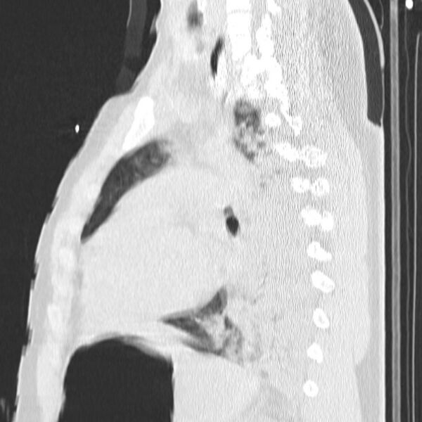 File:Acute aspiration pneumonitis (Radiopaedia 33605-34703 Sagittal lung window 53).jpg