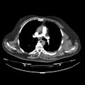 Acute heart failure (CT) (Radiopaedia 79835-93075 Axial C+ arterial phase 7).jpg