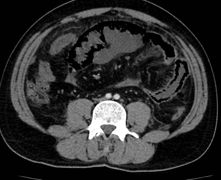 File:Acute mesenteric ischemia - superior mesenteric artery thrombosis (Radiopaedia 73947-84776 Axial C+ arterial phase 88).jpg