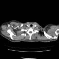 Acute myocarditis (Radiopaedia 55988-62613 C 9).jpg