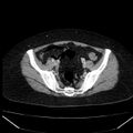 Acute pancreatitis - Balthazar C (Radiopaedia 26569-26714 Axial C+ portal venous phase 78).jpg
