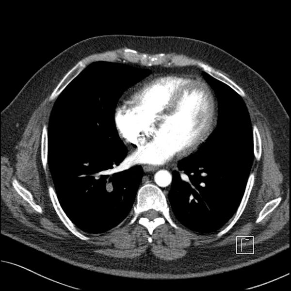 File:Acute pulmonary embolism with pulmonary infarct (Radiopaedia 73062-83768 Axial C+ CTPA 48).jpg