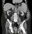 Acute renal failure post IV contrast injection- CT findings (Radiopaedia 47815-52559 Coronal C+ portal venous phase 19).jpg