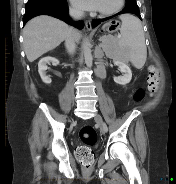File:Acute renal failure post IV contrast injection- CT findings (Radiopaedia 47815-52559 Coronal C+ portal venous phase 19).jpg