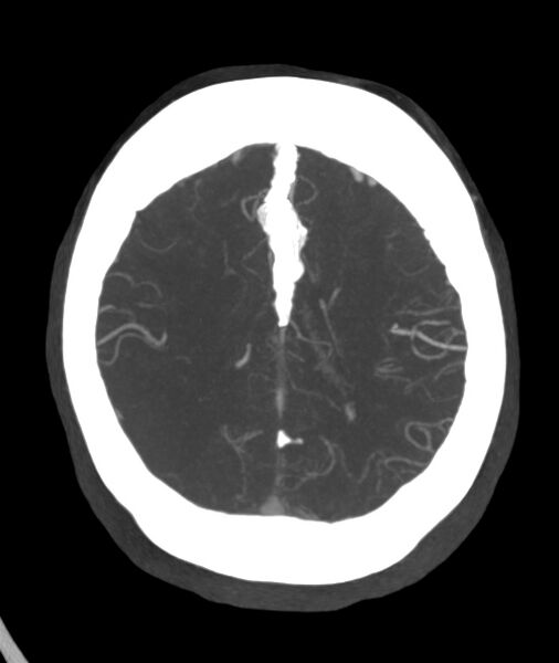 File:Acute right MCA M1 occlusion (Radiopaedia 62268-70454 Axial Phase 1 9).jpg