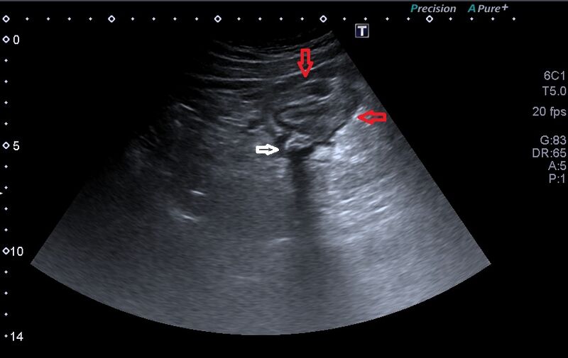 File:Acute right sided diverticulitis (Radiopaedia 65249-74370 Transverse 1).jpg