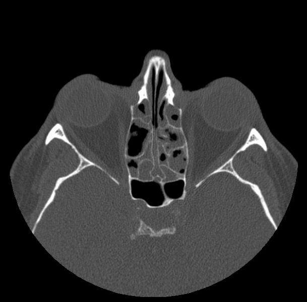 File:Acute sinusitis (Radiopaedia 23161-23215 Axial bone window 44).jpg