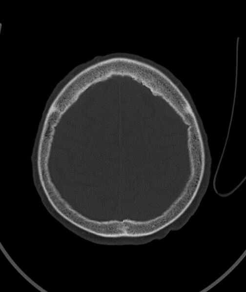 File:Acute traumatic subdural hematoma (Radiopaedia 82921-97257 Axial bone window 27).jpg