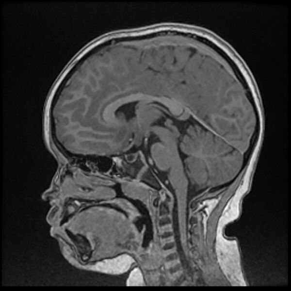 File:Adamantinomatous craniopharyngioma (Radiopaedia 77407-89529 Sagittal T1 C+ 69).jpg