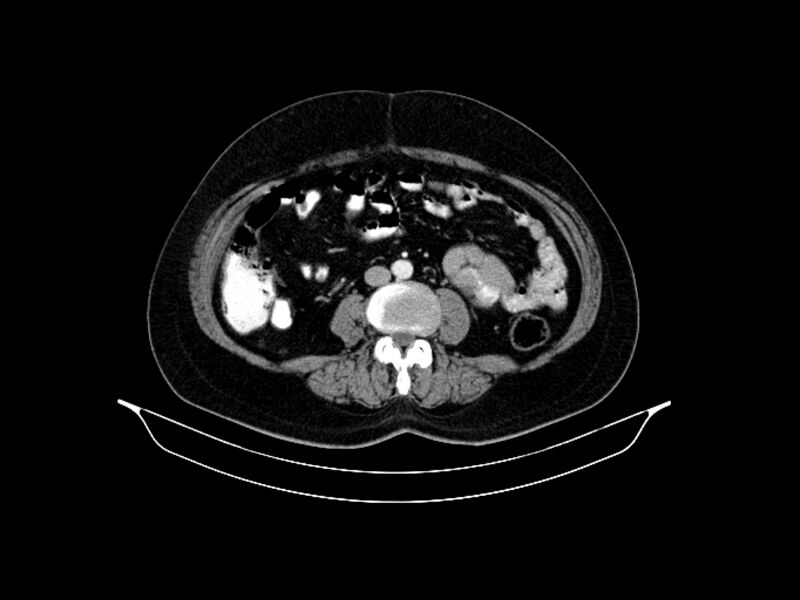 File:Adenocarcinoma of pancreas with hepatic metastasis (Radiopaedia 64332-73122 Axial C+ portal venous phase 60).jpg