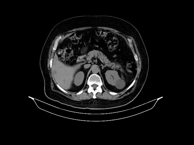 File:Adenocarcinoma of pancreas with hepatic metastasis (Radiopaedia 64332-73122 Axial non-contrast 35).jpg