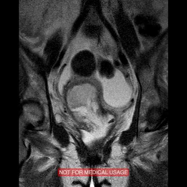 File:Adenocarcinoma of the cervix (Radiopaedia 28373-28615 Coronal T2 11).jpg