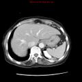 Adenocarcinoma of the colon (Radiopaedia 8191-9039 Axial liver window 14).jpg