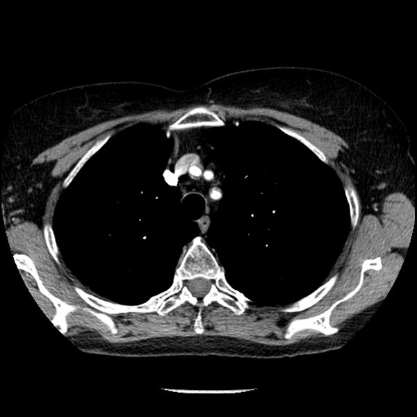 File:Adenocarcinoma of the lung (Radiopaedia 41015-43755 Axial C+ portal venous phase 28).jpg