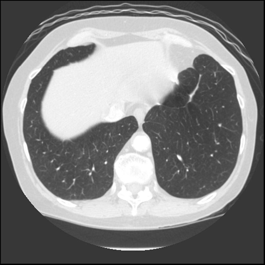 Adenocarcinoma of the lung (Radiopaedia 41015-43755 Axial lung window 101).jpg