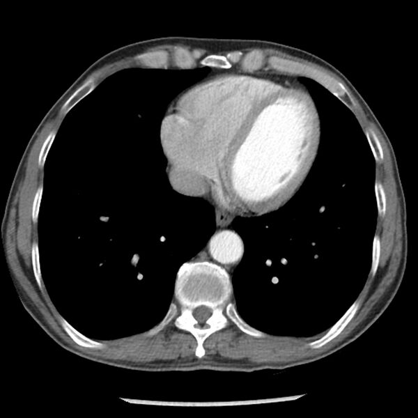 File:Adenocarcinoma of the lung - micropapillary predominant (Radiopaedia 42446-45563 Axial C+ portal venous phase 53).jpg