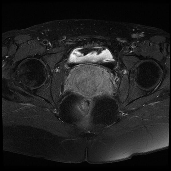 File:Adenomyosis-scar endometriosis (Radiopaedia 65863-75022 Axial T1 C+ fat sat 19).jpg
