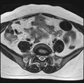 Adenomyosis - ovarian endometriomas (Radiopaedia 67031-76350 Axial T2 5).jpg