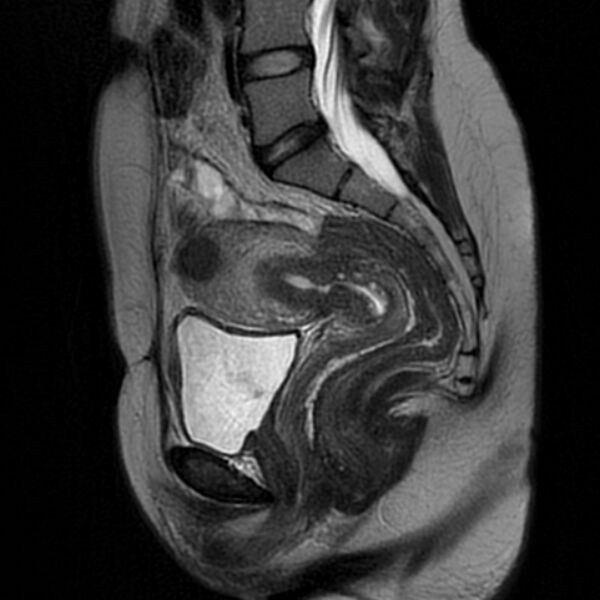 File:Adenomyosis within a septate uterus (Radiopaedia 69963-79981 Sagittal T2 16).jpg