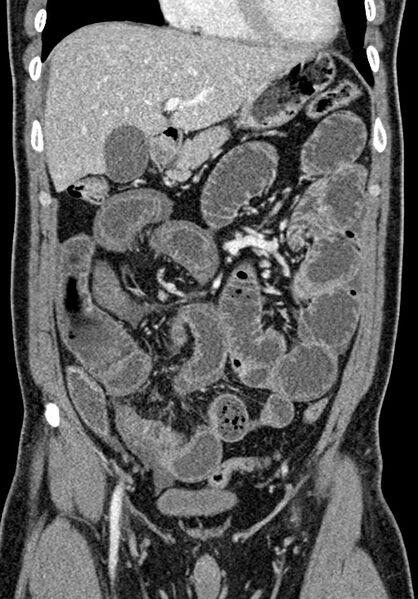 File:Adhesional small bowel obstruction (Radiopaedia 58900-66131 Coronal C+ portal venous phase 109).jpg