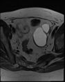 Adnexal multilocular cyst (O-RADS US 3- O-RADS MRI 3) (Radiopaedia 87426-103754 Axial T2 12).jpg
