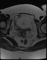 Adnexal multilocular cyst (O-RADS US 3- O-RADS MRI 3) (Radiopaedia 87426-103754 Axial T2 17).jpg