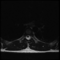 Aggressive vertebral hemangioma (Radiopaedia 39937-42404 Axial T2 25).png