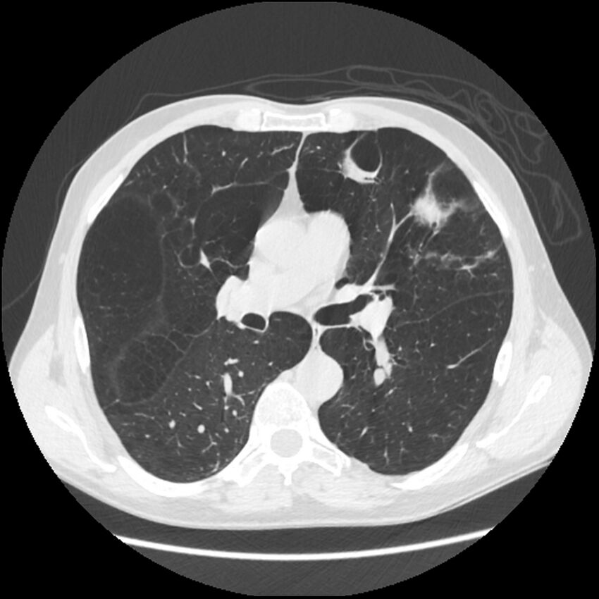 Alpha-1-antitrypsin deficiency (Radiopaedia 40993-43722 Axial lung window 110).jpg