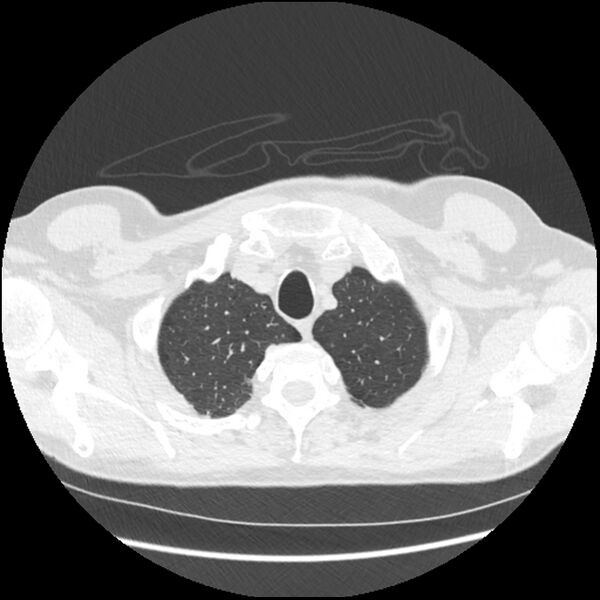 File:Alpha-1-antitrypsin deficiency (Radiopaedia 40993-43722 Axial lung window 23).jpg