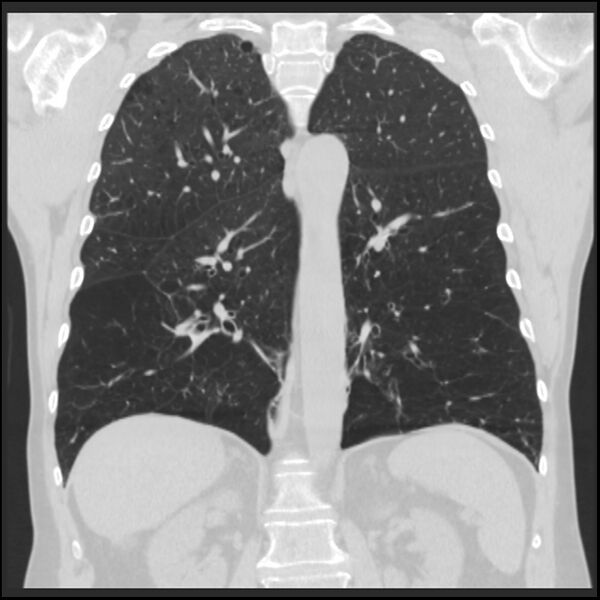 File:Alpha-1-antitrypsin deficiency (Radiopaedia 40993-43722 Coronal lung window 67).jpg