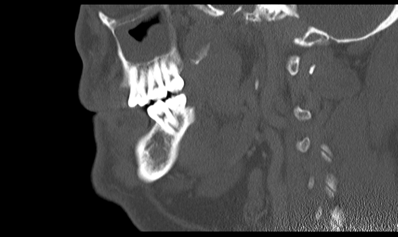 File:Ameloblastoma (Radiopaedia 33677-34806 Sagittal bone window 42).png